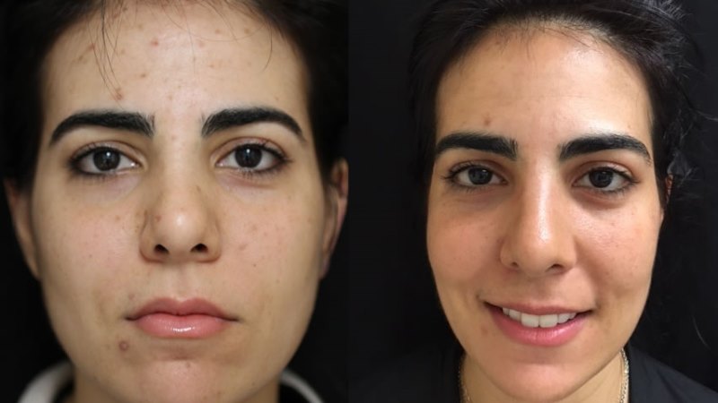 Acne Scar Removal – New Age Methods For Clear Skin