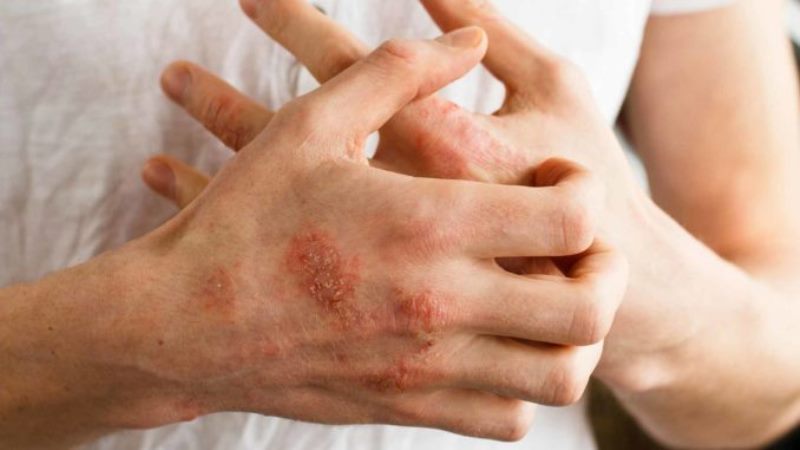 Dead Sea Salt Eczema – Natural Home Treatment and Remedy For Eczema