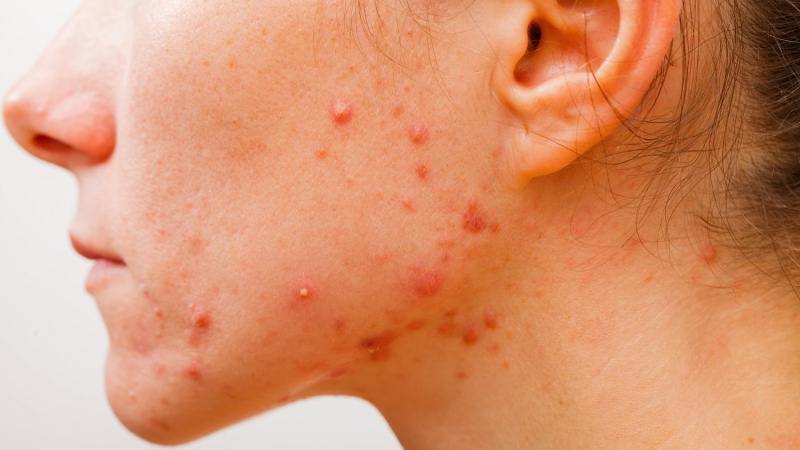 Acne Free In 3 Days – What’s It All About